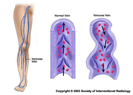 illustration of normal vein vs. varicose vein