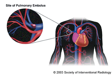 Pulmonary embolism illustration